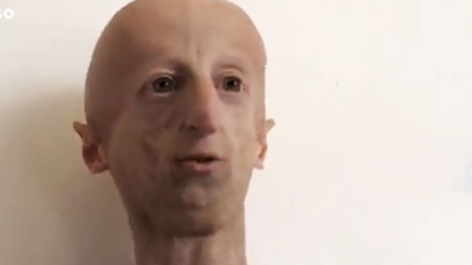 Choroba progeria
