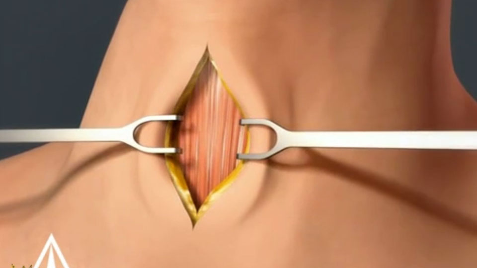 Tracheotomia jak wygląda